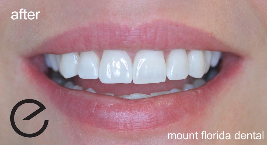 after tooth whitening