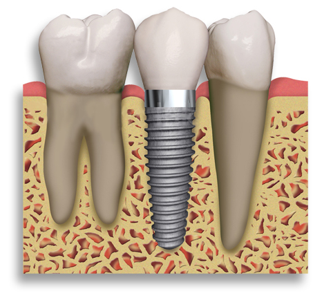 Dental Implants Glasgow