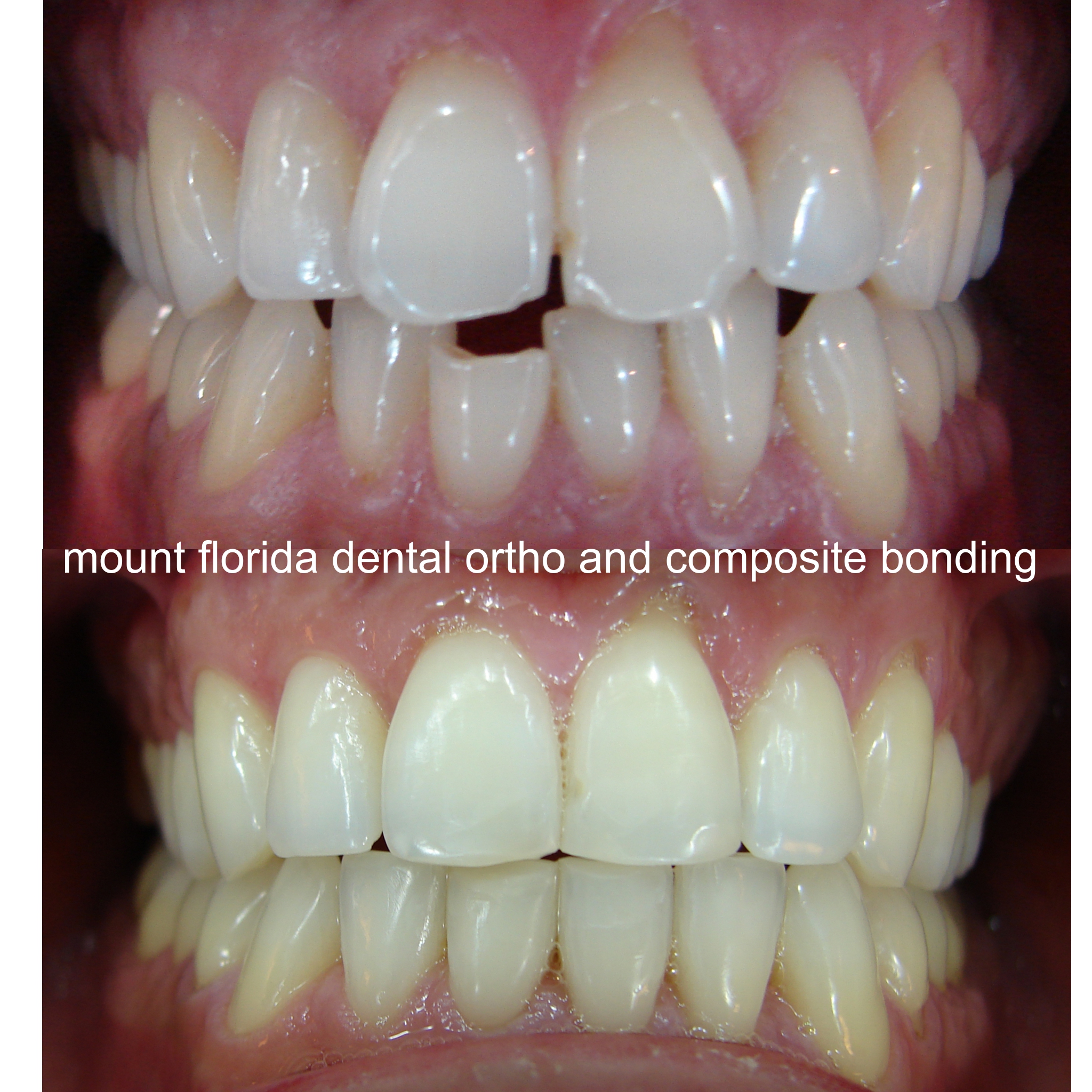 ortho composite bonding